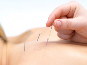 dry needling met focus op naalden